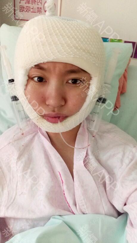 氧气5793901528280616V-LINE瓜子脸手术第