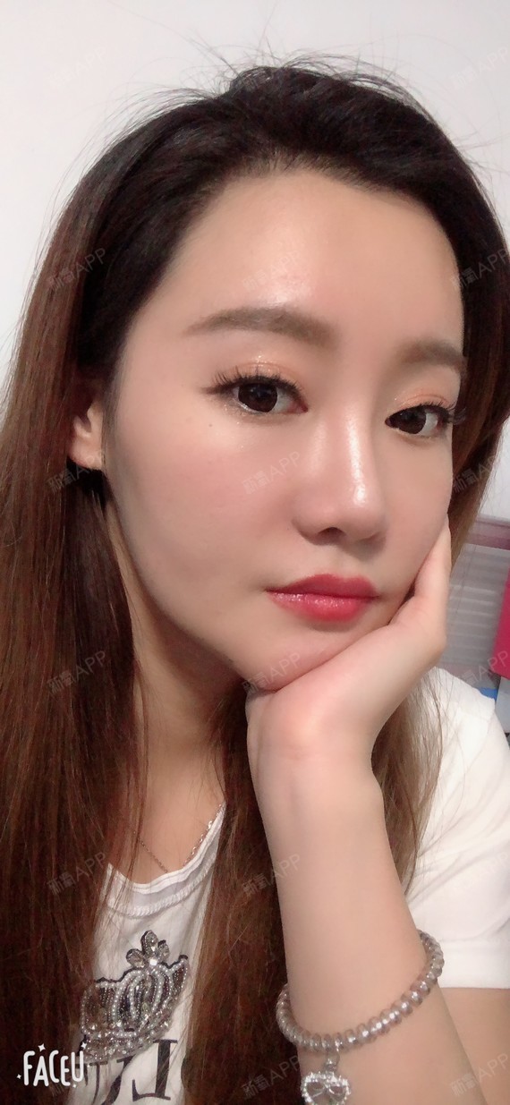 赵三金面部吸脂第25天美丽日记-新氧美容整形