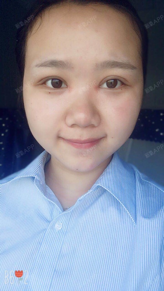 阿尔法的猫切开双眼皮第15天美丽日记-新氧美