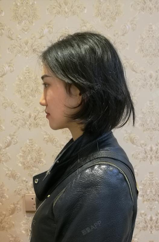 528778371隐形托槽矫正第1天美丽日记-新氧美