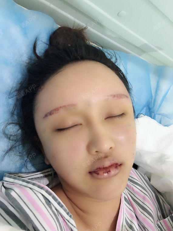 m唇手术