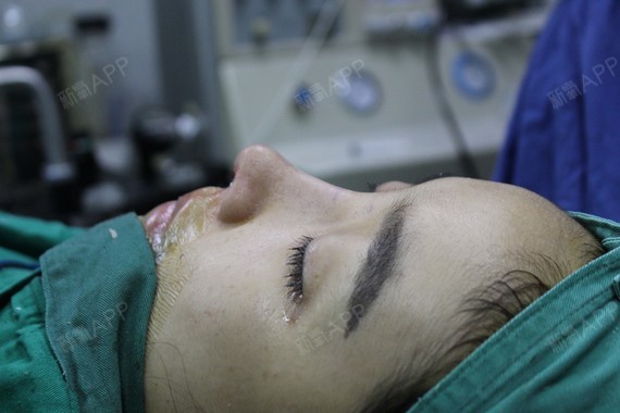 琼瑶琼瑶鼻综合第0天美丽日记-新氧美容整形