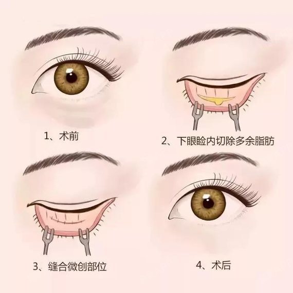 外路祛眼袋 沿下睑睫毛下缘至外眦沟切开 摘除膨出的眼袋脂肪