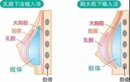 隆胸后,会降低胸部敏感度吗?真相在这里._圈子-新氧