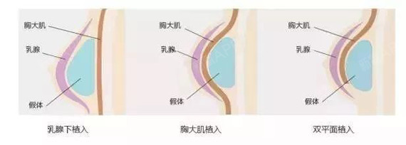 至于乳房下皱壁切口 因为刚好位于乳房下皱襞处 采用胸大肌或