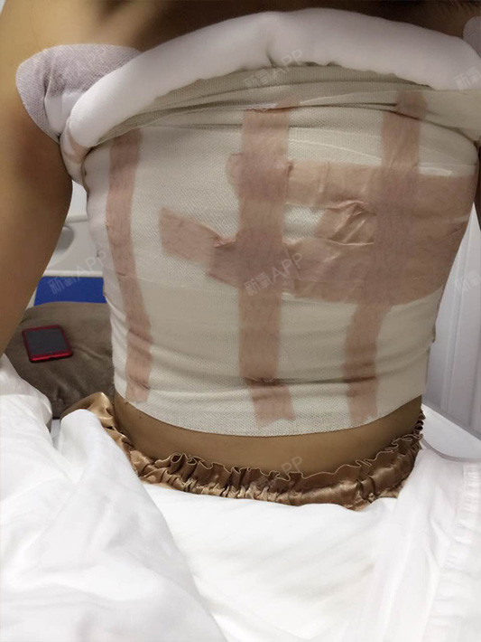 想你了呢怎么办假体隆胸第5天美丽日记-新氧美