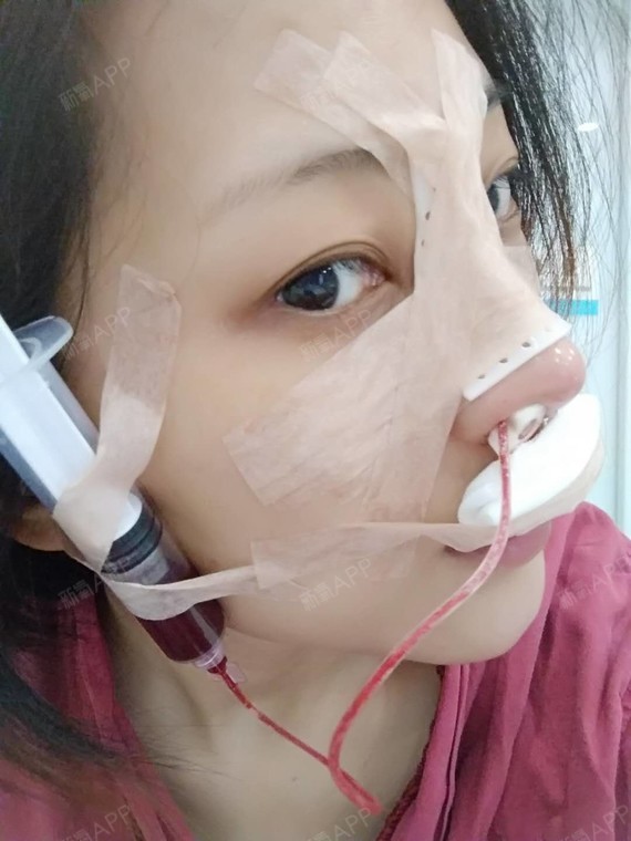 如果云知道a肋软骨隆鼻第0天美丽日记-新氧美