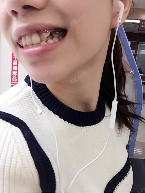 虎牙长得太上了,之前身边朋友都说虎牙蛮可爱的,但是由于右边虎牙突出