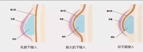 假体一般会植入上面所说的三个位置:乳腺下,胸大肌和双平面(也就是