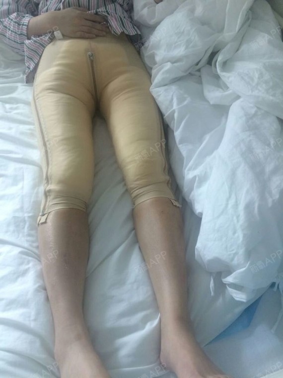 新氧- 氧气1452771527646040 | 美体塑形 | 吸脂瘦大腿 | 术后当自强