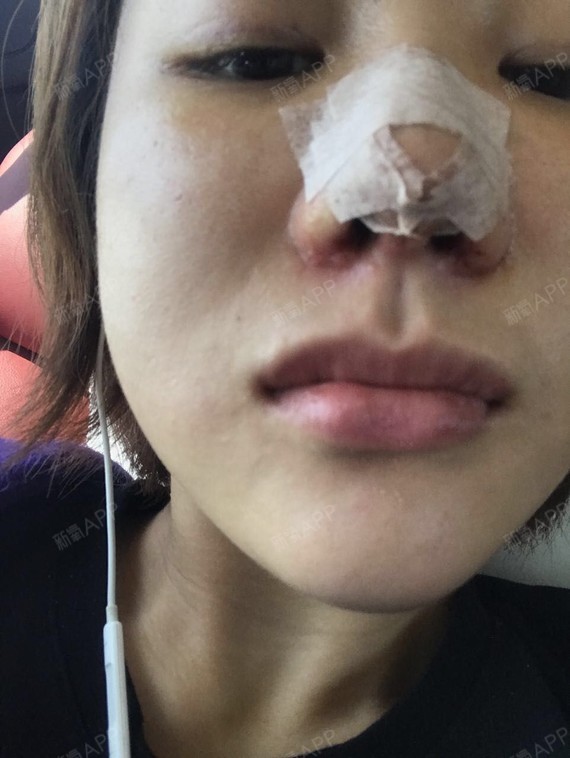 浪漫樱花落鼻综合第5天美丽日记-新氧美容整形