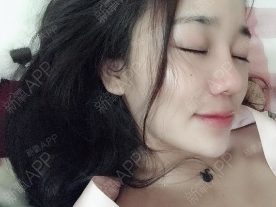 郑梅美膨体隆鼻第160天美丽日记-新氧美容整形