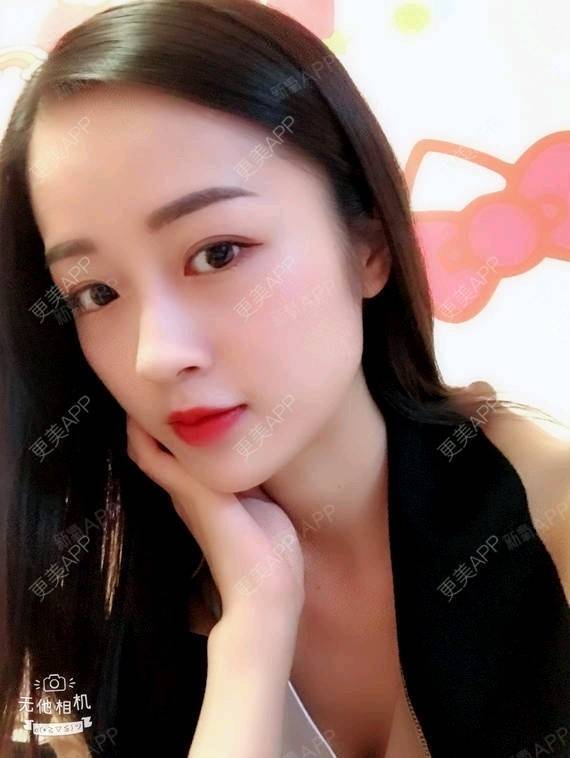 天火同人肋软骨隆鼻第43天美丽日记-新氧美容