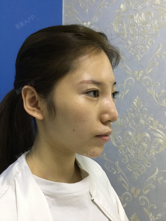 子Fanny激光去眼袋第0天美丽日记-新氧美容整