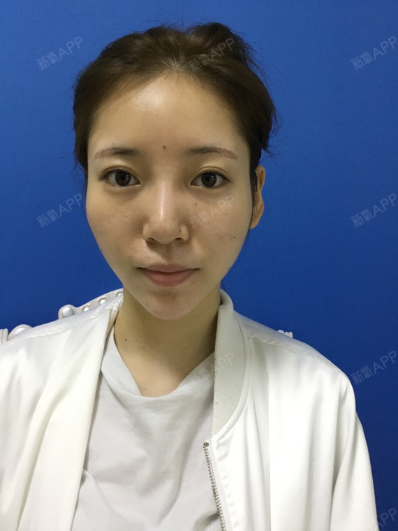 子Fanny激光去眼袋第0天美丽日记-新氧美容整