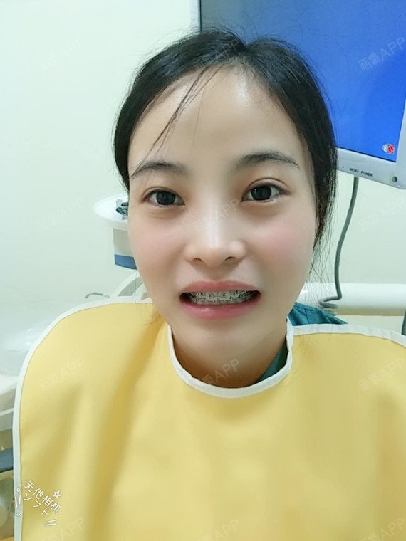 个像夏天一个秋天隐形托槽矫正第430天美丽日