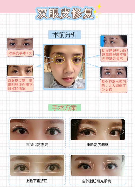 【眼部修复】【双眼皮多重睑修复】三层或多层双眼皮
