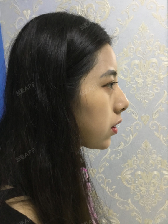 子Fanny激光去眼袋第1天美丽日记-新氧美容整