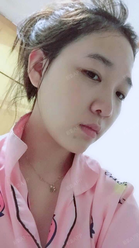 好吃不如热干面面部吸脂第17天美丽日记-新氧