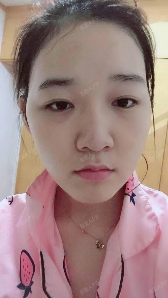 好吃不如热干面面部吸脂第17天美丽日记-新氧