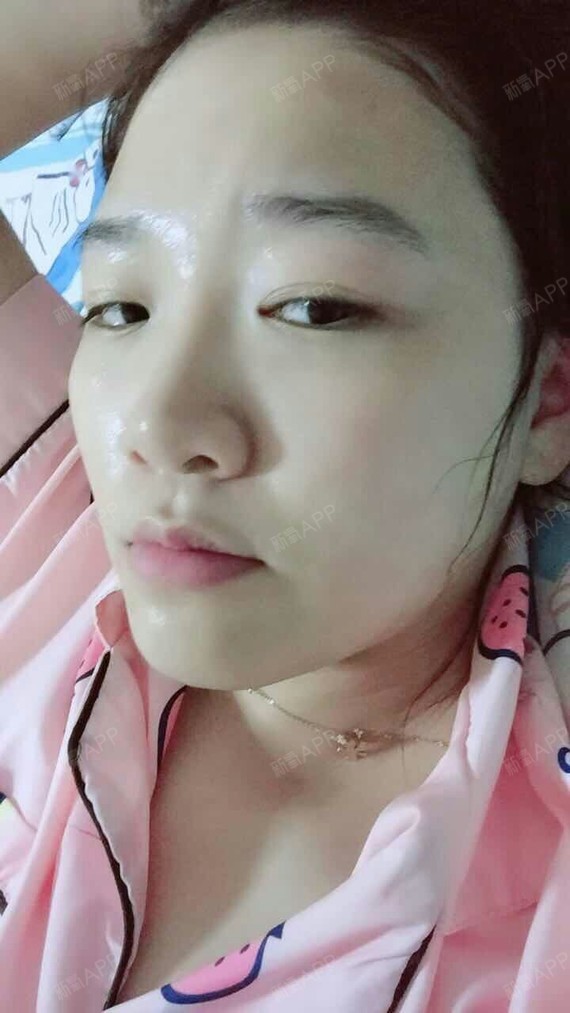 好吃不如热干面面部吸脂第17天美丽日记-新氧