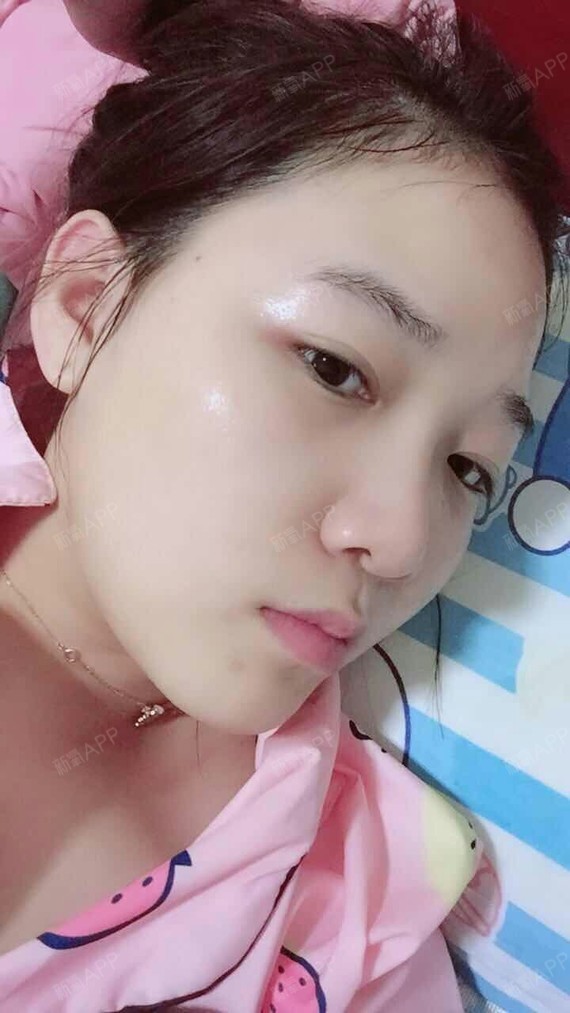 好吃不如热干面面部吸脂第17天美丽日记-新氧