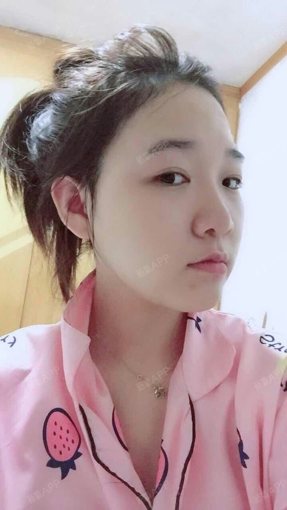 好吃不如热干面面部吸脂第17天美丽日记-新氧