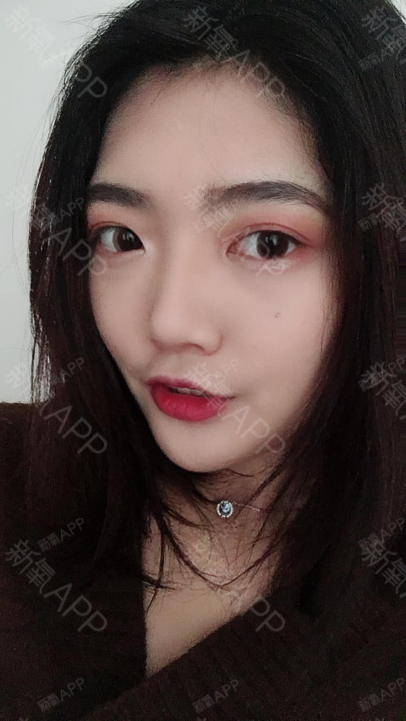 氧气2931101529287821切开双眼皮第59天美