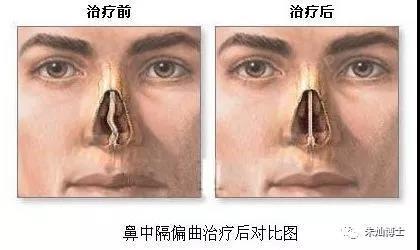 关于各类歪鼻矫正的详解方法鼻子位于我们面部的中心