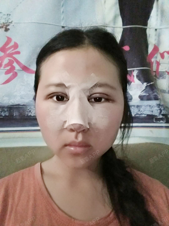 su0eoyk12硅胶隆鼻第0天美丽日记-新氧美容整