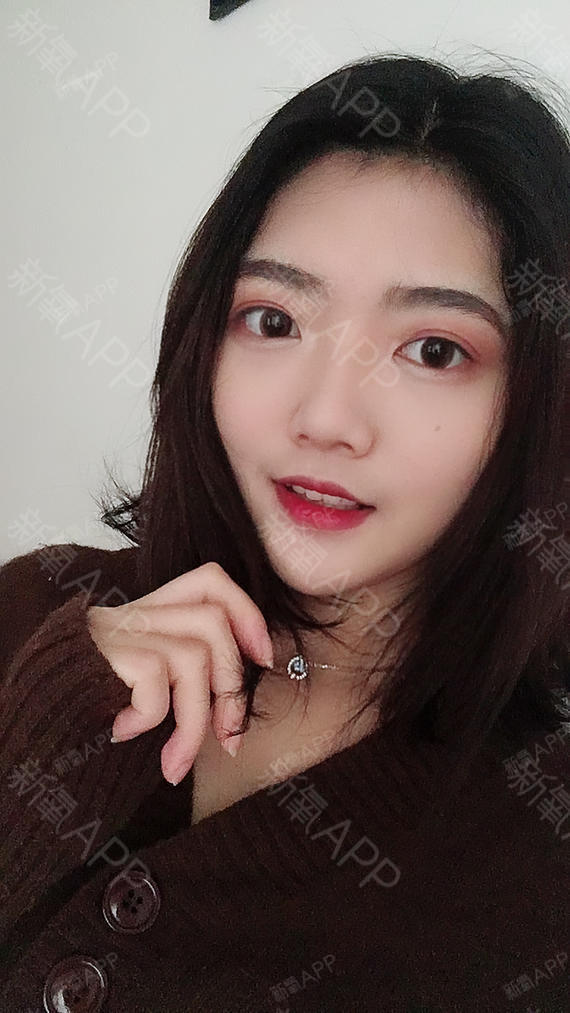 氧气2931101529287821切开双眼皮第59天美