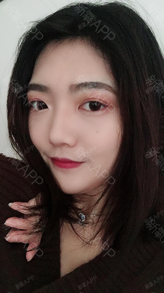 氧气2931101529287821切开双眼皮第59天美