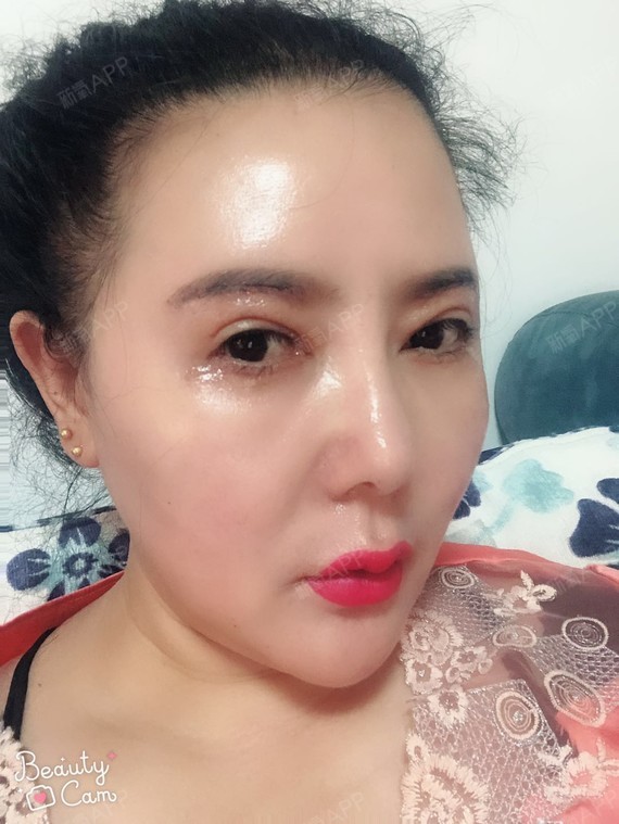 新氧- 氧气3419661521186625 | 眼部 | 眼袋 | 外切去眼袋 | 内切去