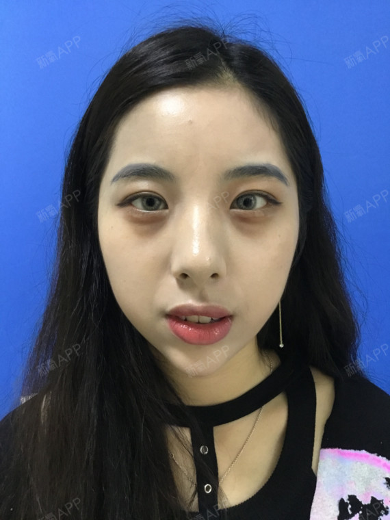 子Fanny激光去眼袋第0天美丽日记-新氧美容整