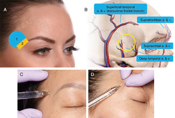 透明质酸&肉毒毒素安全注射指南:上面部