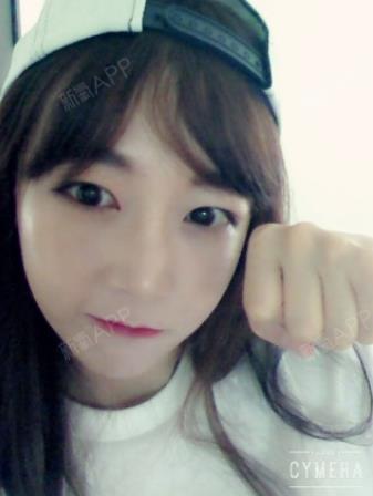 周雨幕膨体隆鼻第60天美丽日记-新氧美容整形