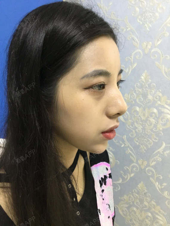 子Fanny激光去眼袋第0天美丽日记-新氧美容整