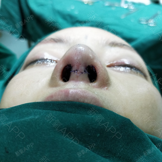 JiNG鼻部硅胶假体取出第0天美丽日记-新氧美