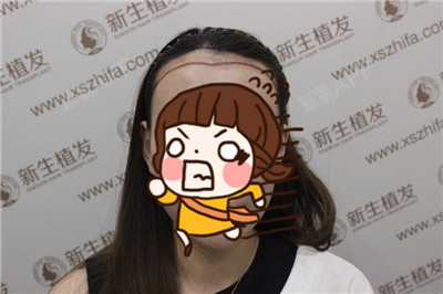 nikooo种植发际线第0天美丽日记-新氧美容整形