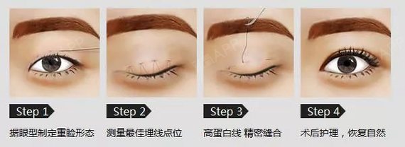 想割双眼皮,不知道要选哪种割法?全切和埋线有