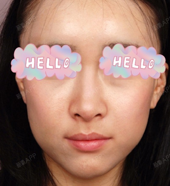 氧气6225471529996805自体脂肪丰苹果肌第6