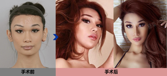 偏中性,偏man的脸,也能通过id面部轮廓女性化手术来改善