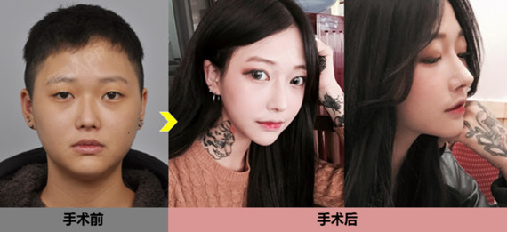 偏中性,偏man的脸,也能通过id面部轮廓女性化手术来改善