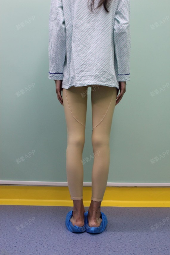 噜啦噜啦好开心吸脂瘦小腿第1天美丽日记-新氧