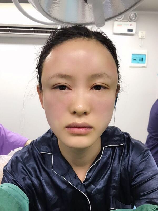 自体脂肪全脸填充