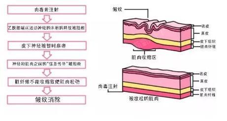 随着年龄的增大,面部容积开始流失 脸部的肌肉动作会强化脸部的纹路