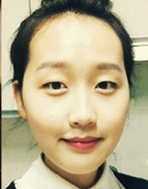 银发美女下颌角整形第30天美丽日记-新氧美容