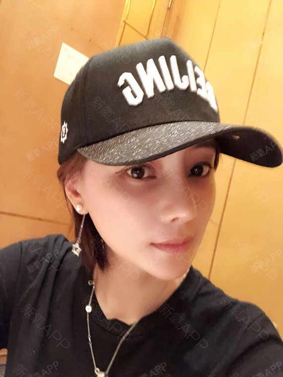 JiNG鼻部硅胶假体取出第15天美丽日记-新氧美