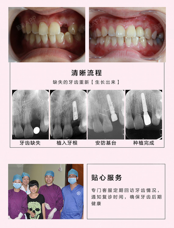 【种植牙】韩国登腾种植牙 10余年专业医师 定制全瓷牙冠 可升级半口