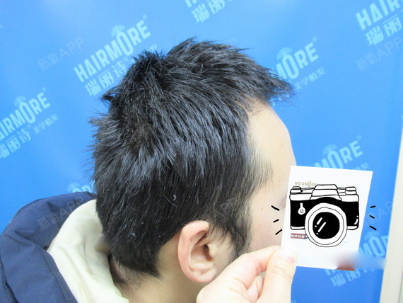 bigbig大元星种植发际线第90天美丽日记-新氧